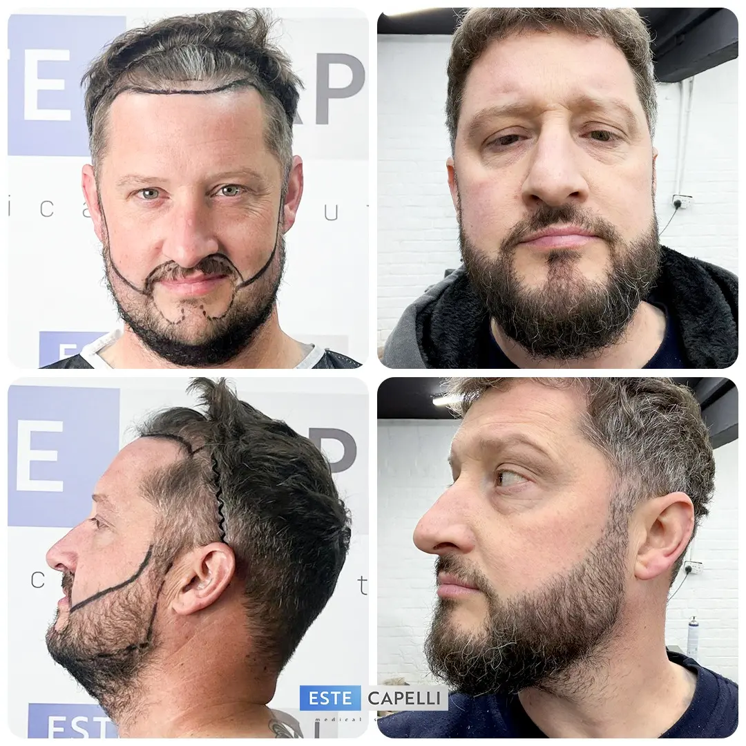 Before and after result