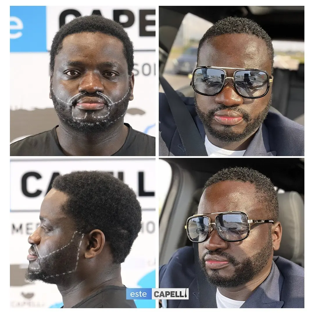 Before and after result