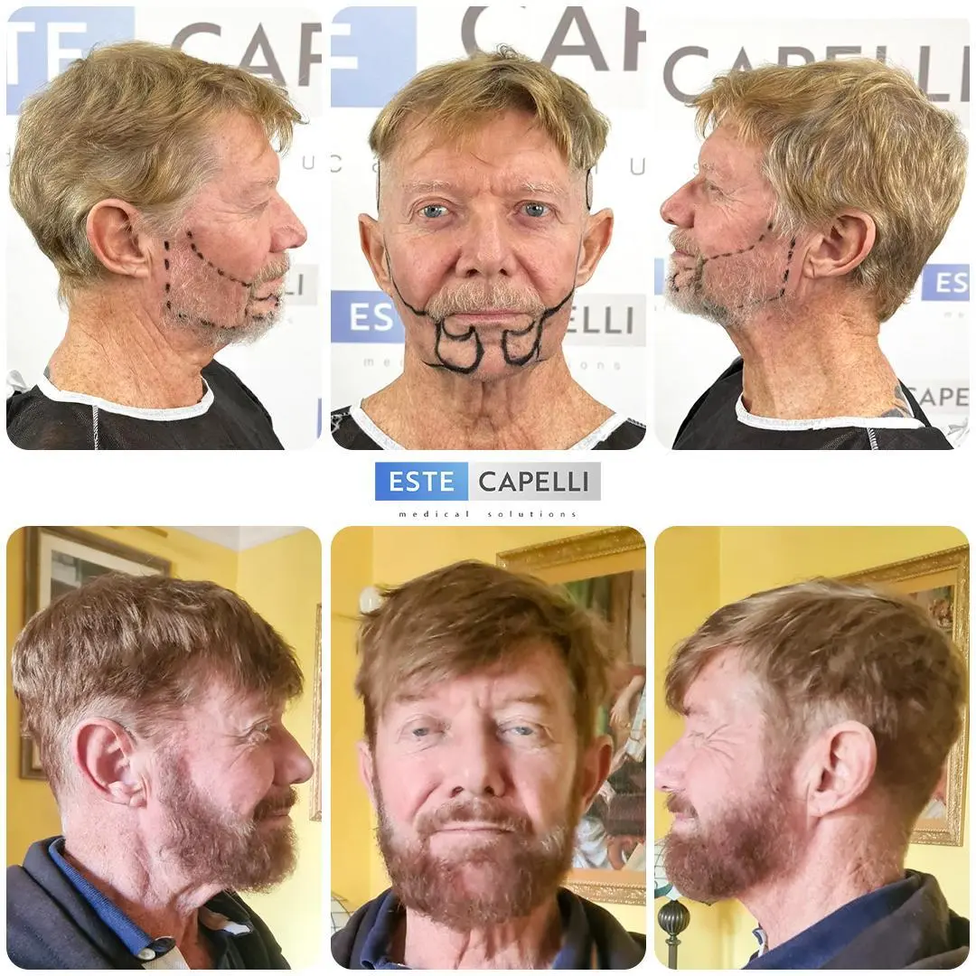 Before and after result