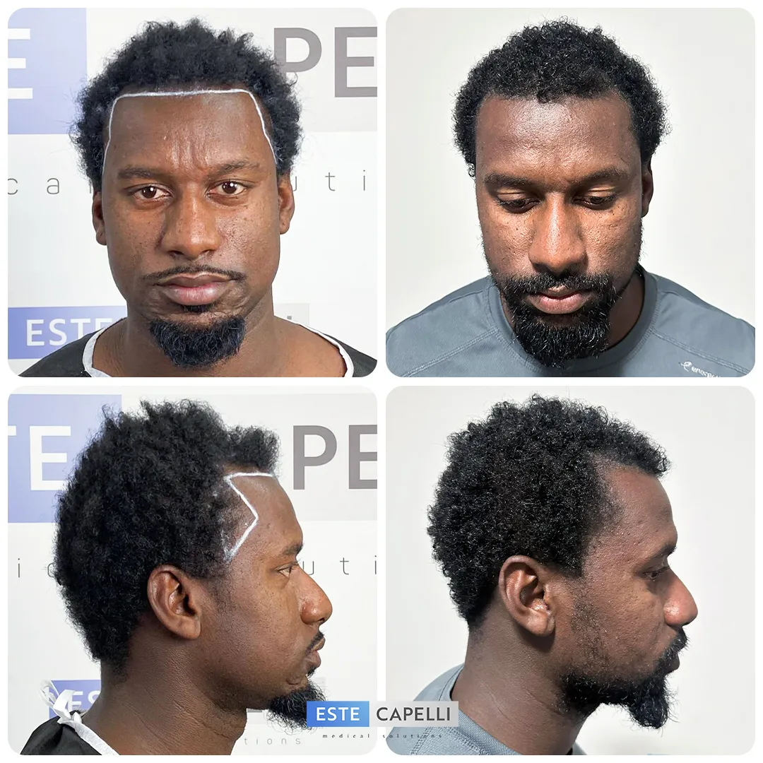 Before and after result