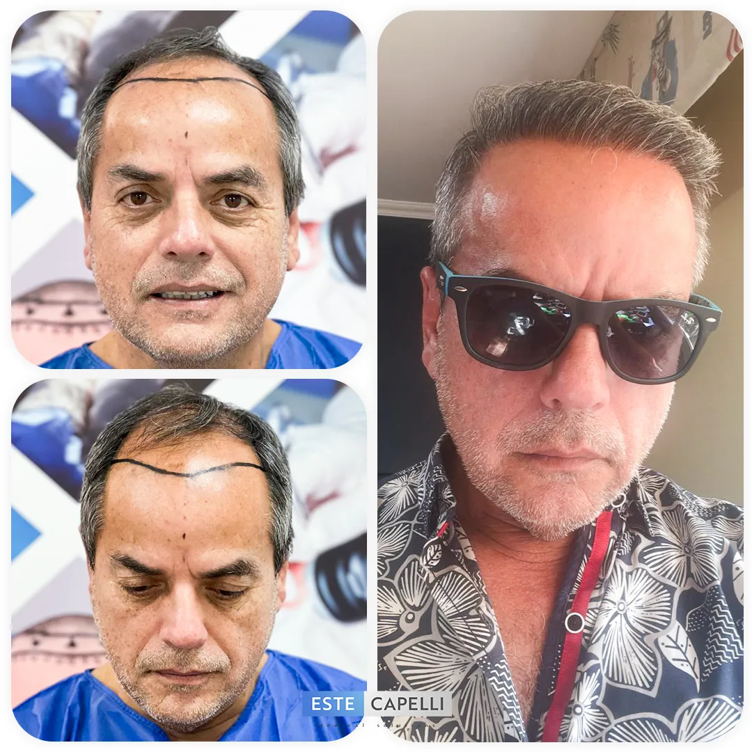 Before and after result