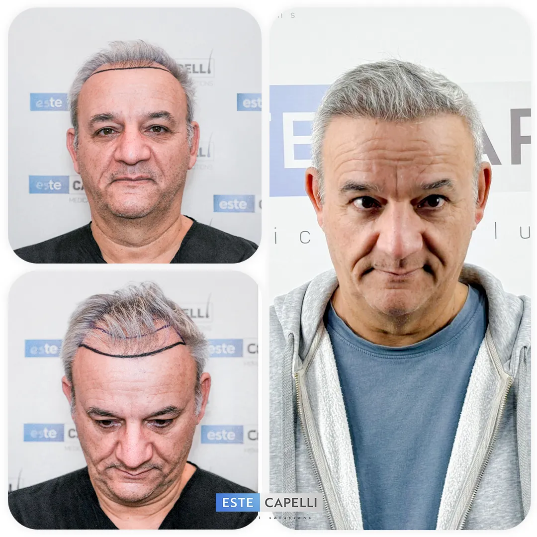 Before and after result