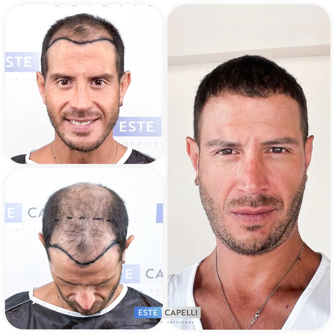 Before and after result