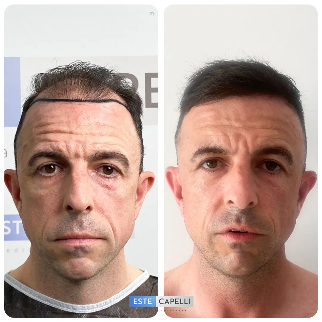 Before and after result