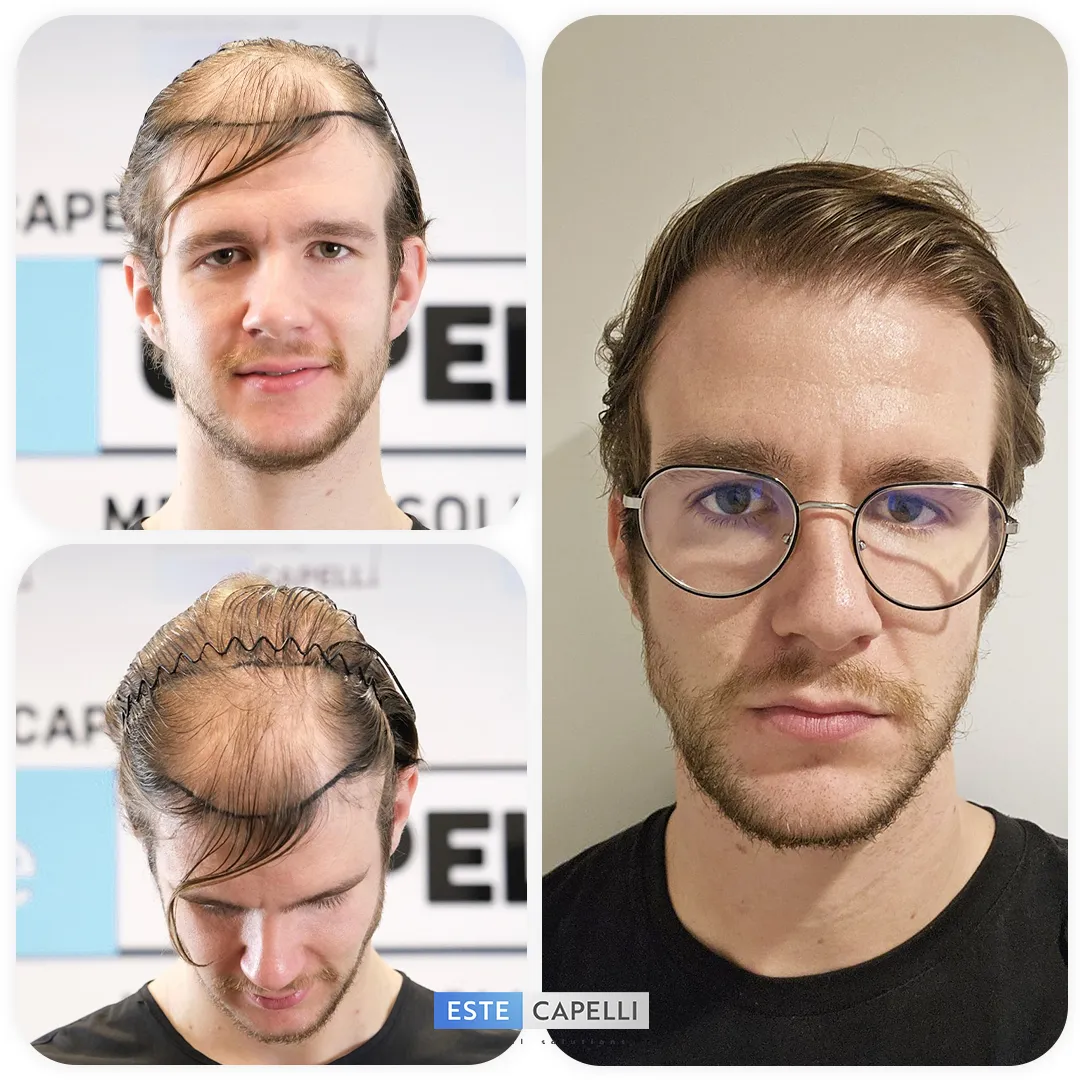 Before and after result
