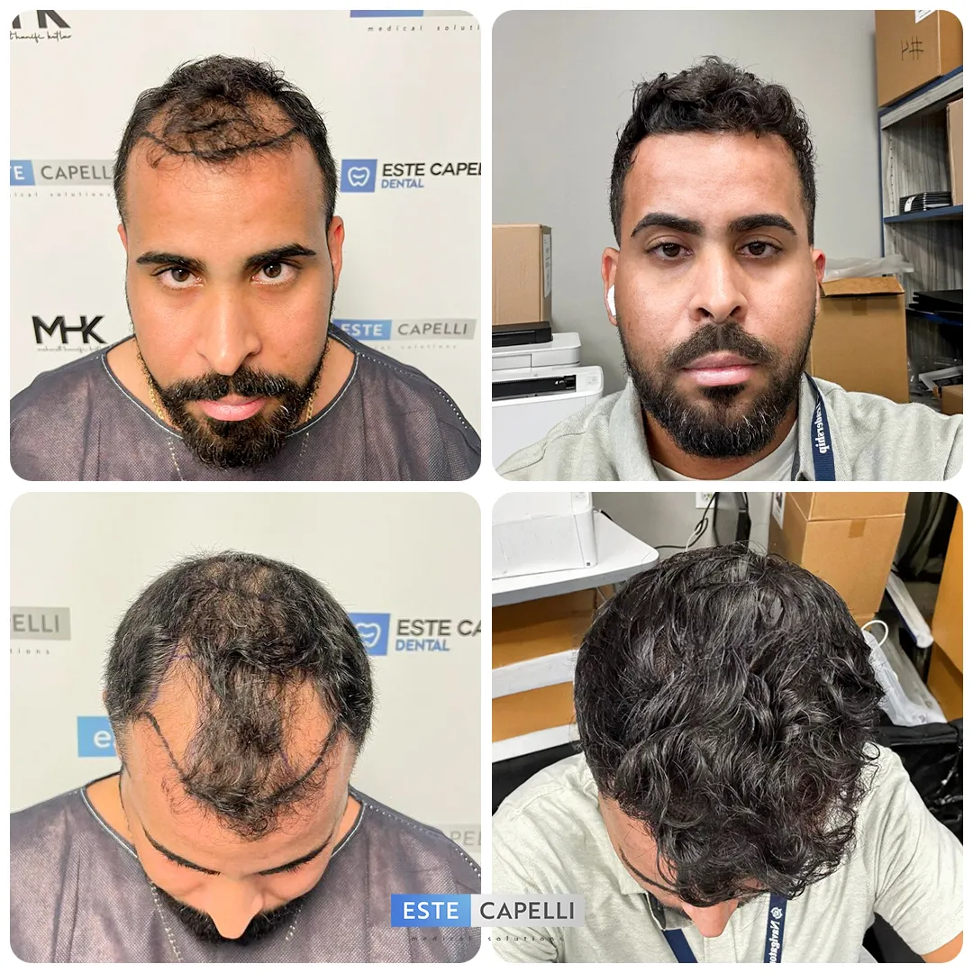 Before and after result