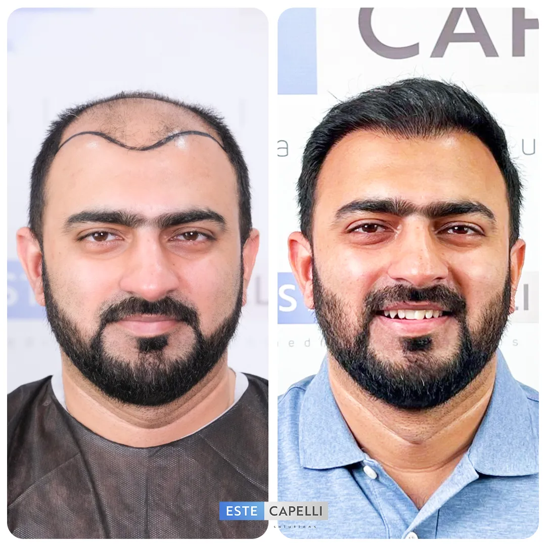 Before and after result