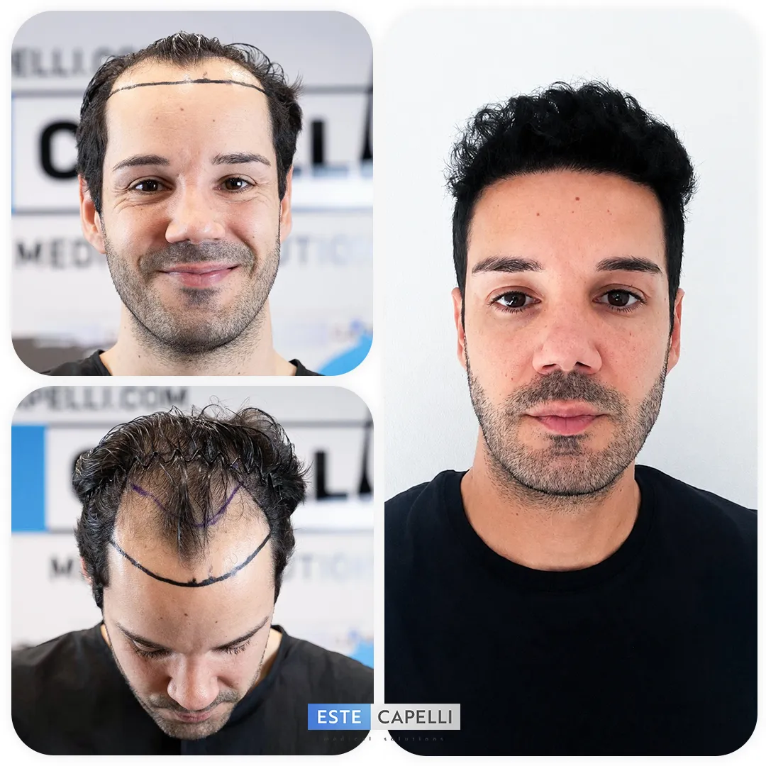 Before and after result