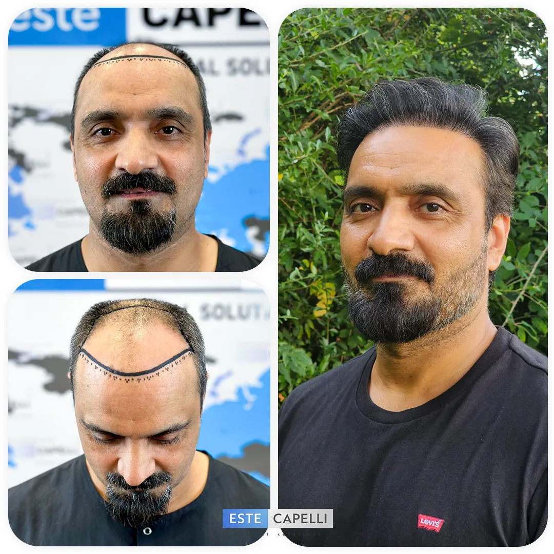 Before and after result