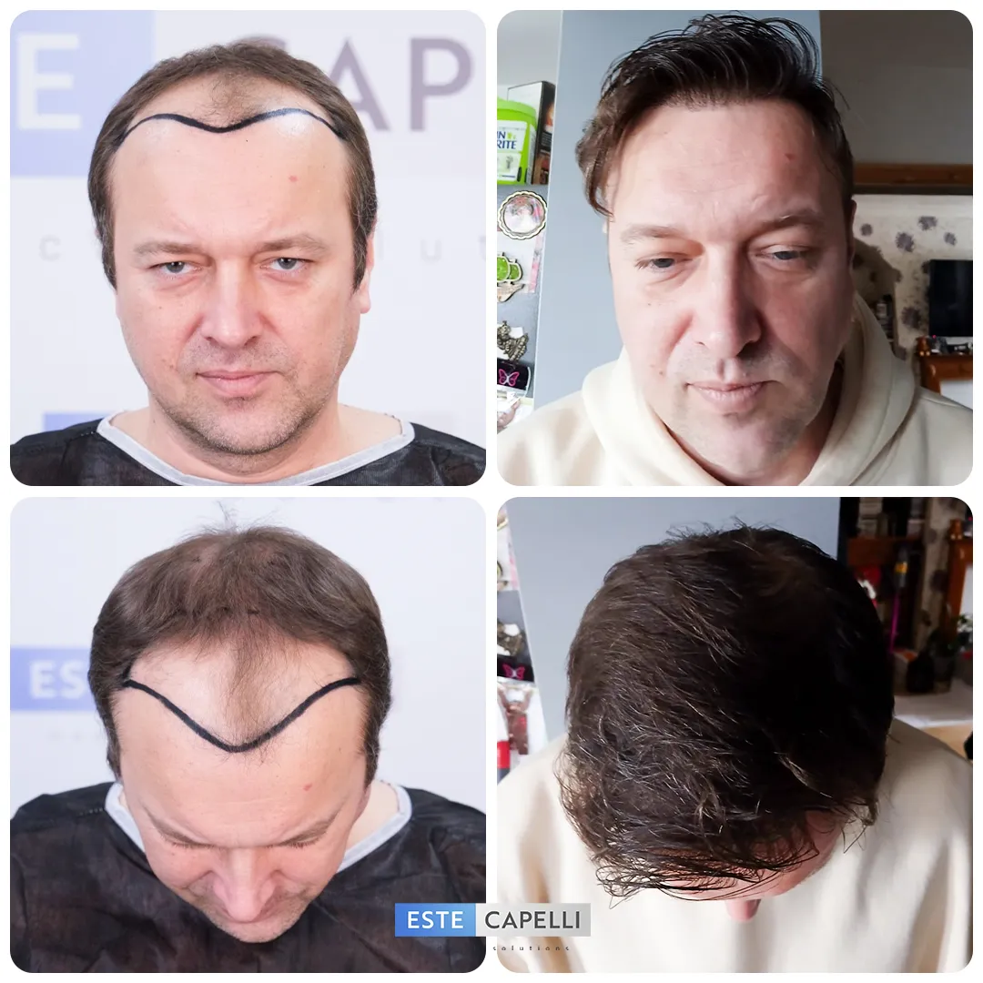 Before and after result