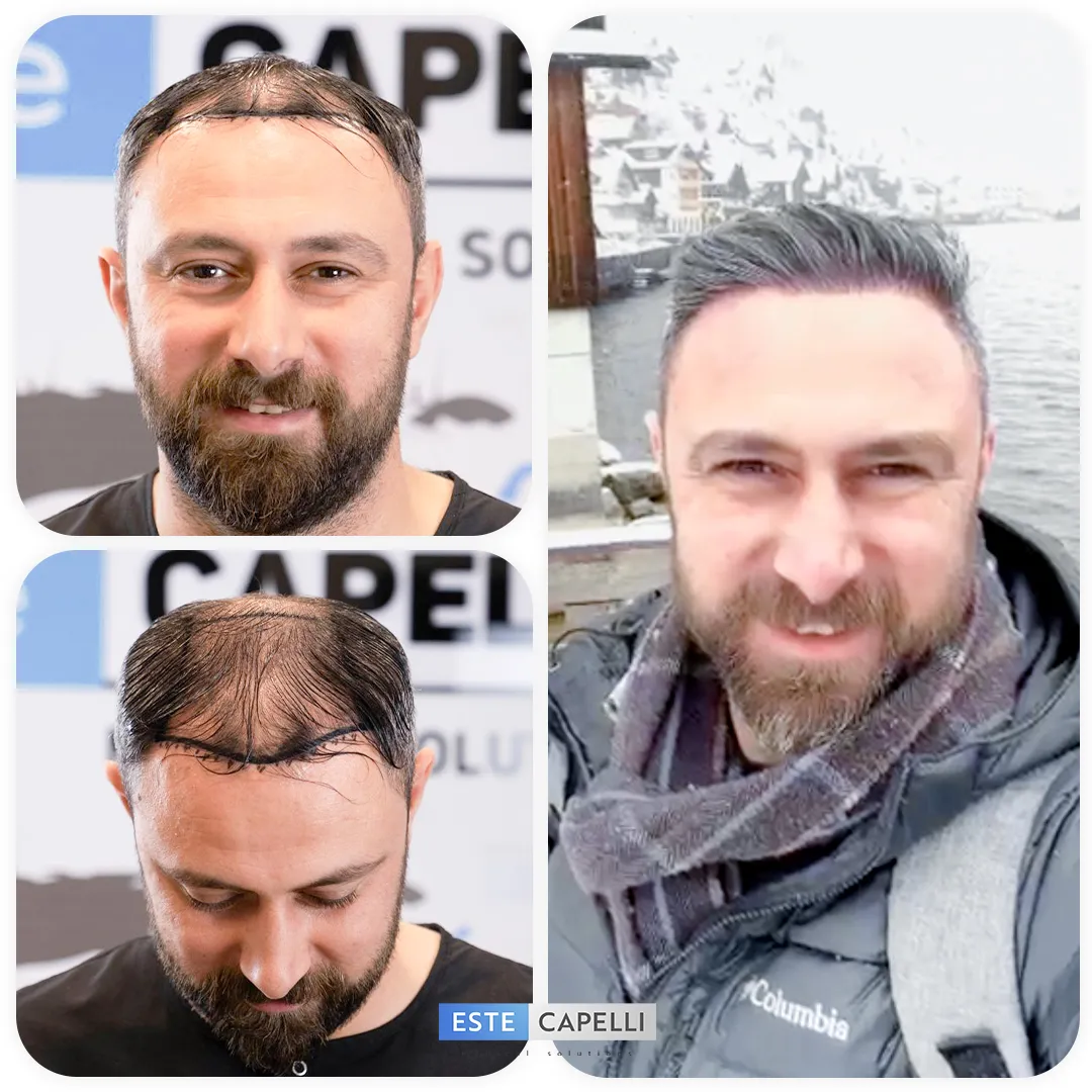 Before and after result