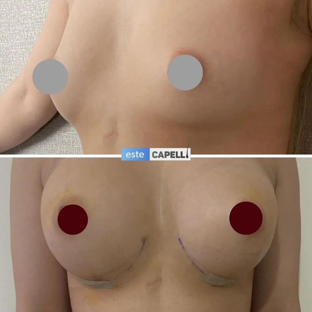 Before and after result