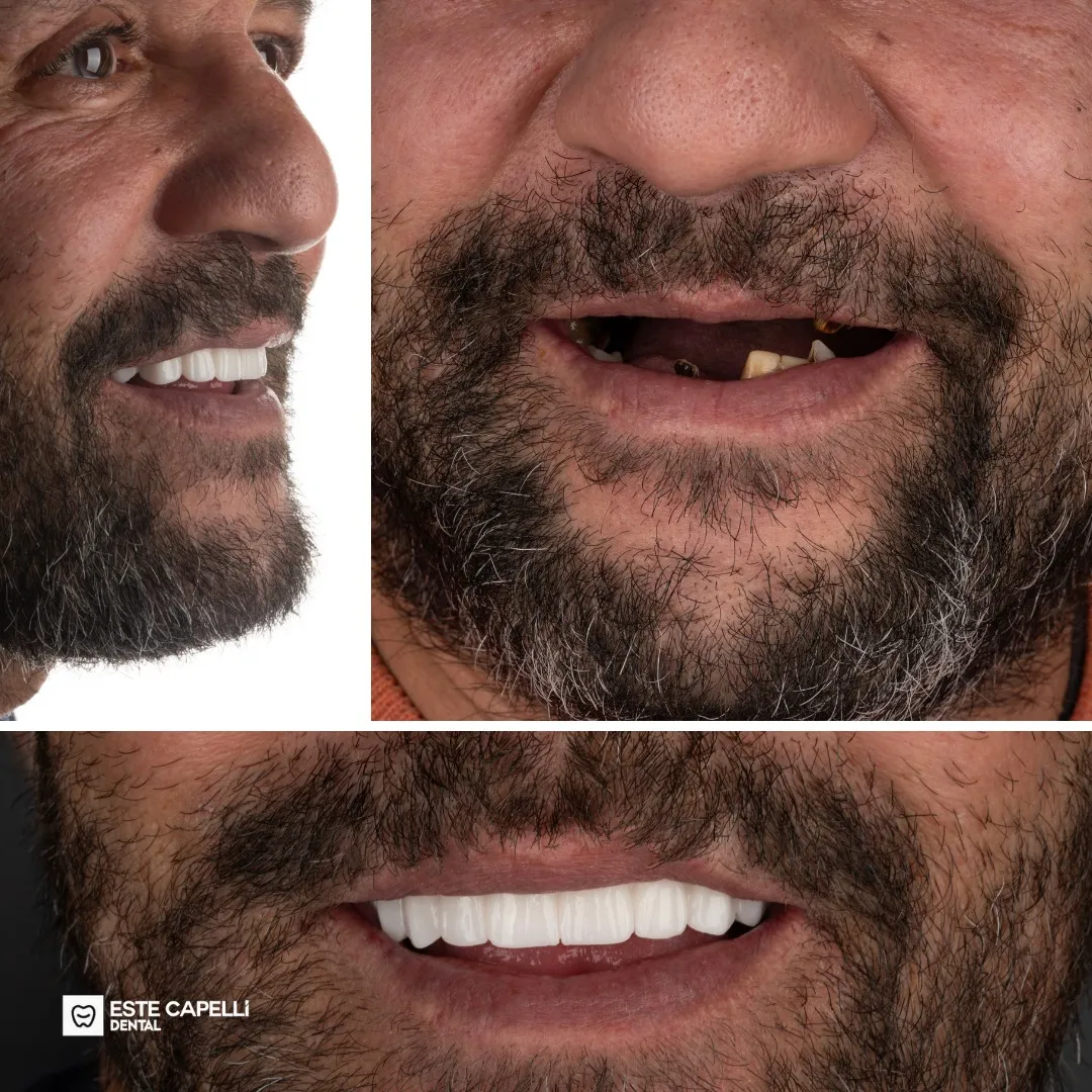 Before and after result