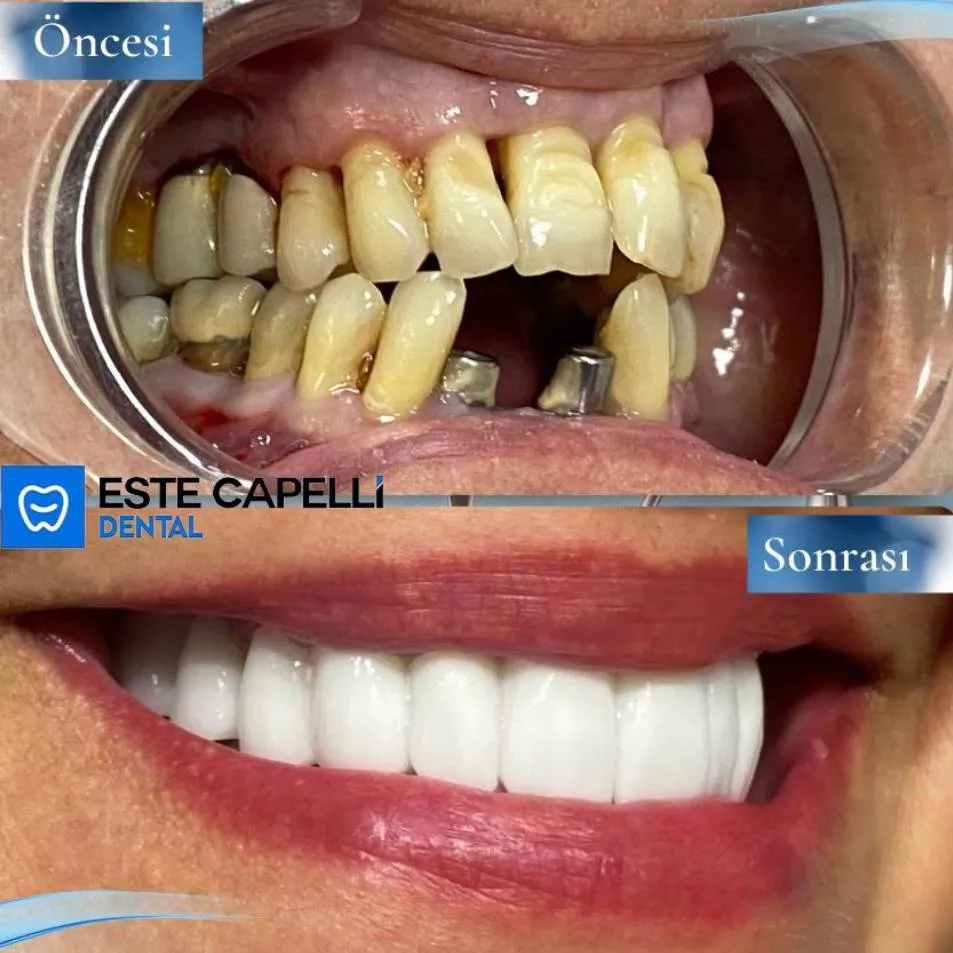 Before and after result