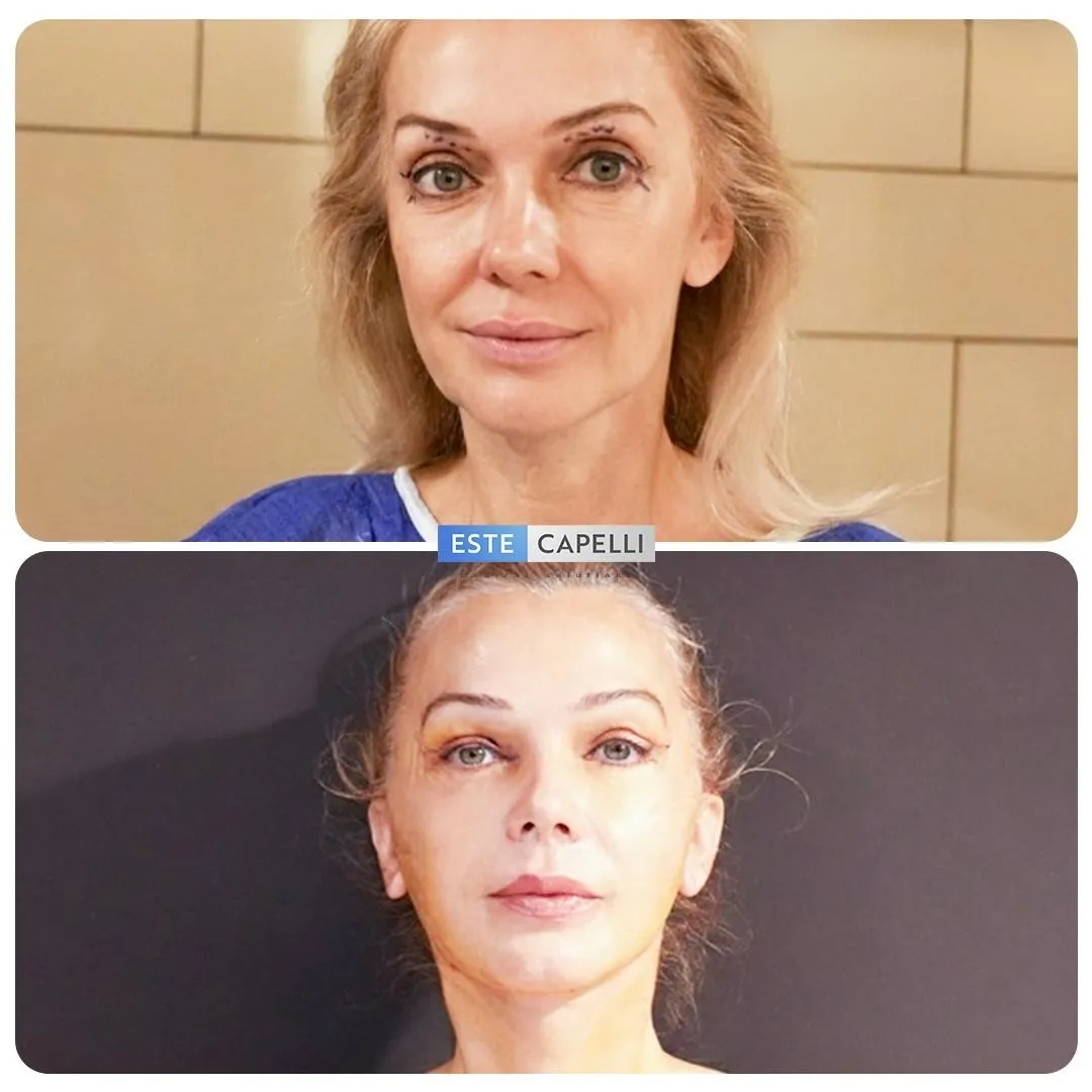 Before and after result