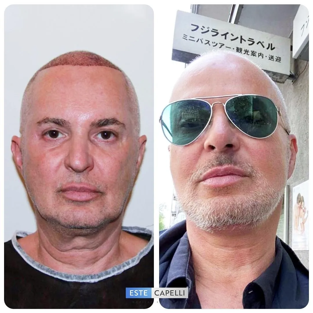 Before and after result