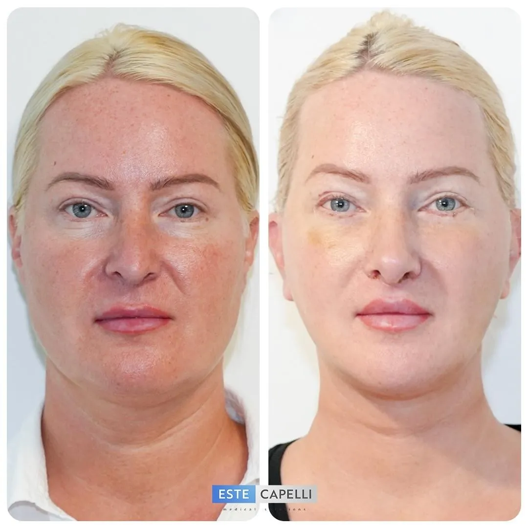 Before and after result