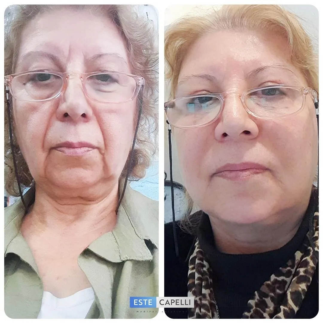 Before and after result