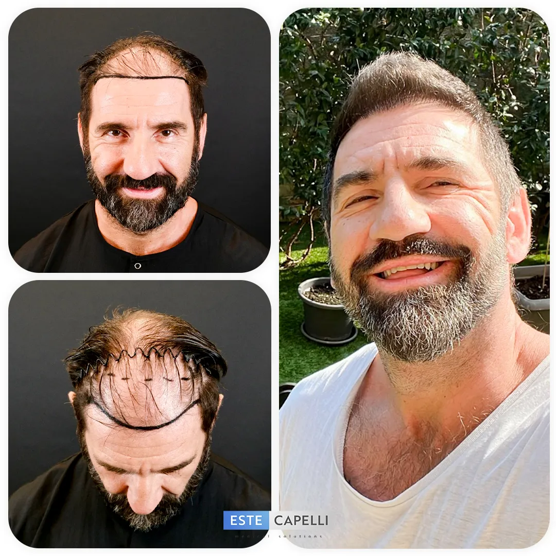 Before and after result