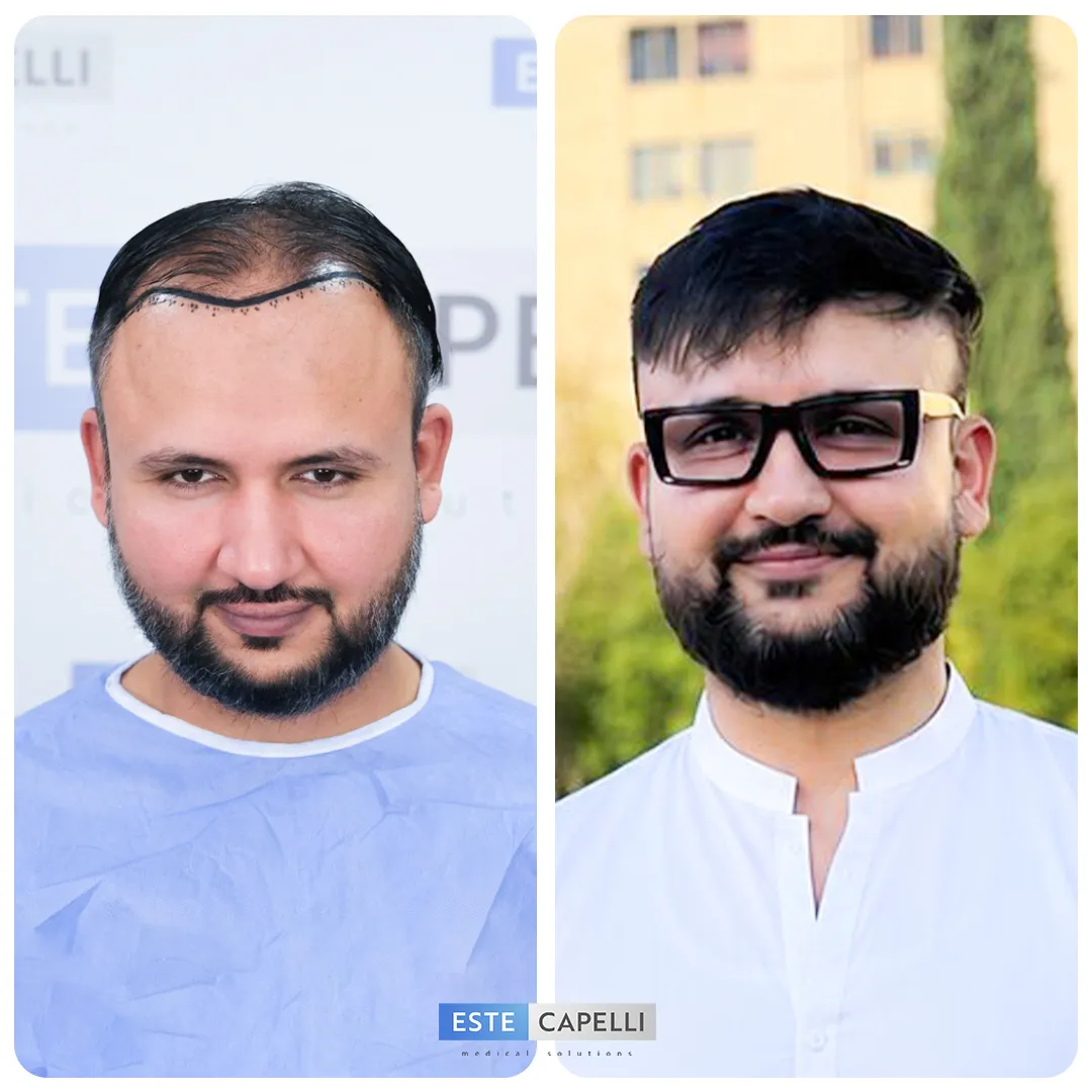 Before and after result
