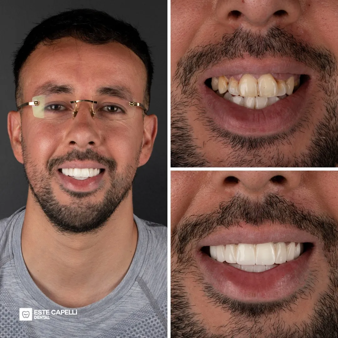 Before and after result