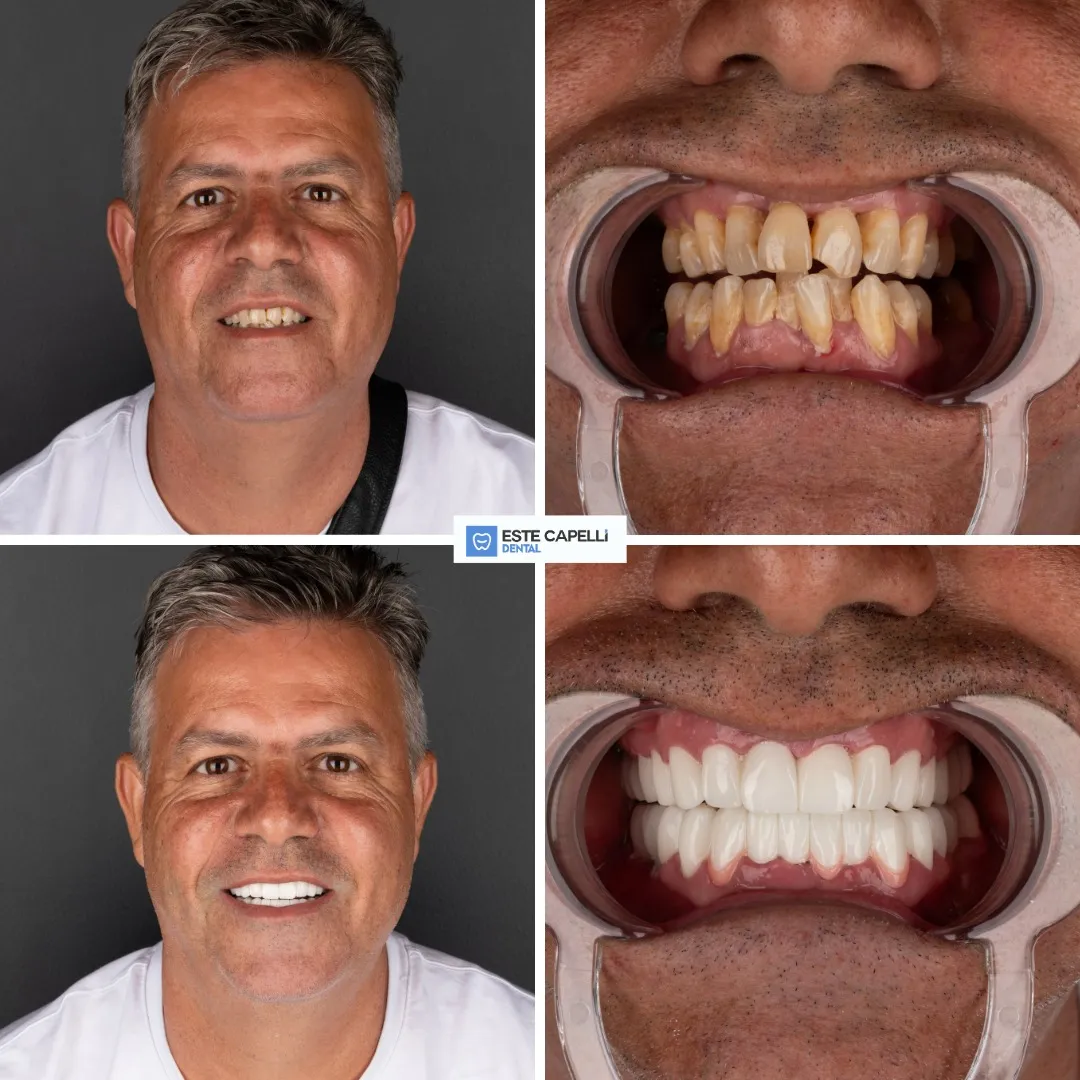Before and after result