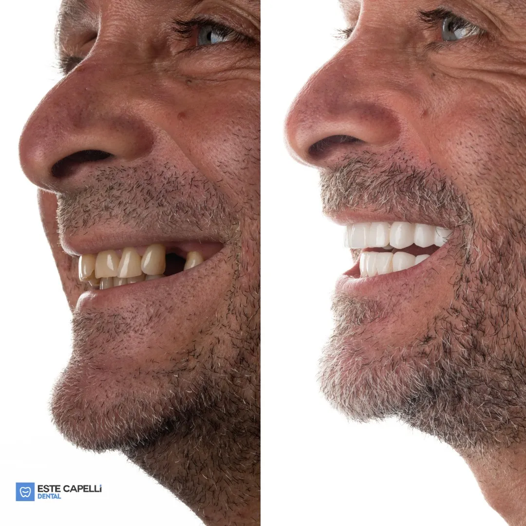 Before and after result