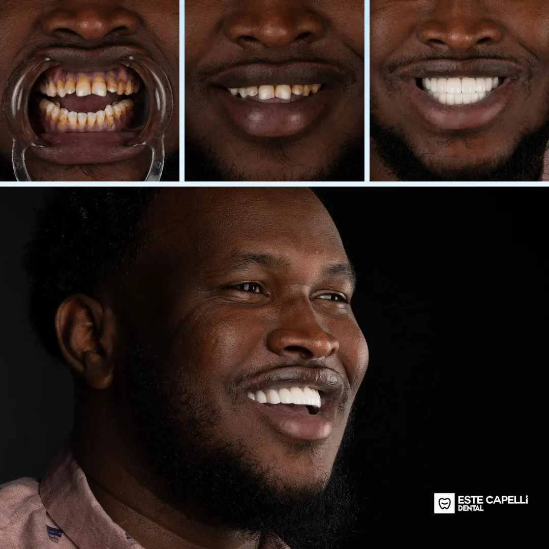 Before and after result
