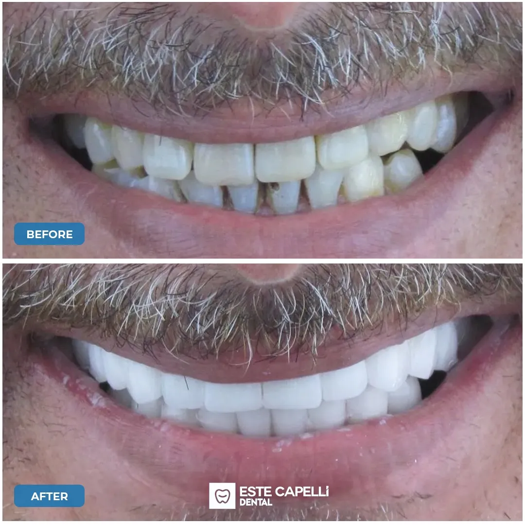 Before and after result