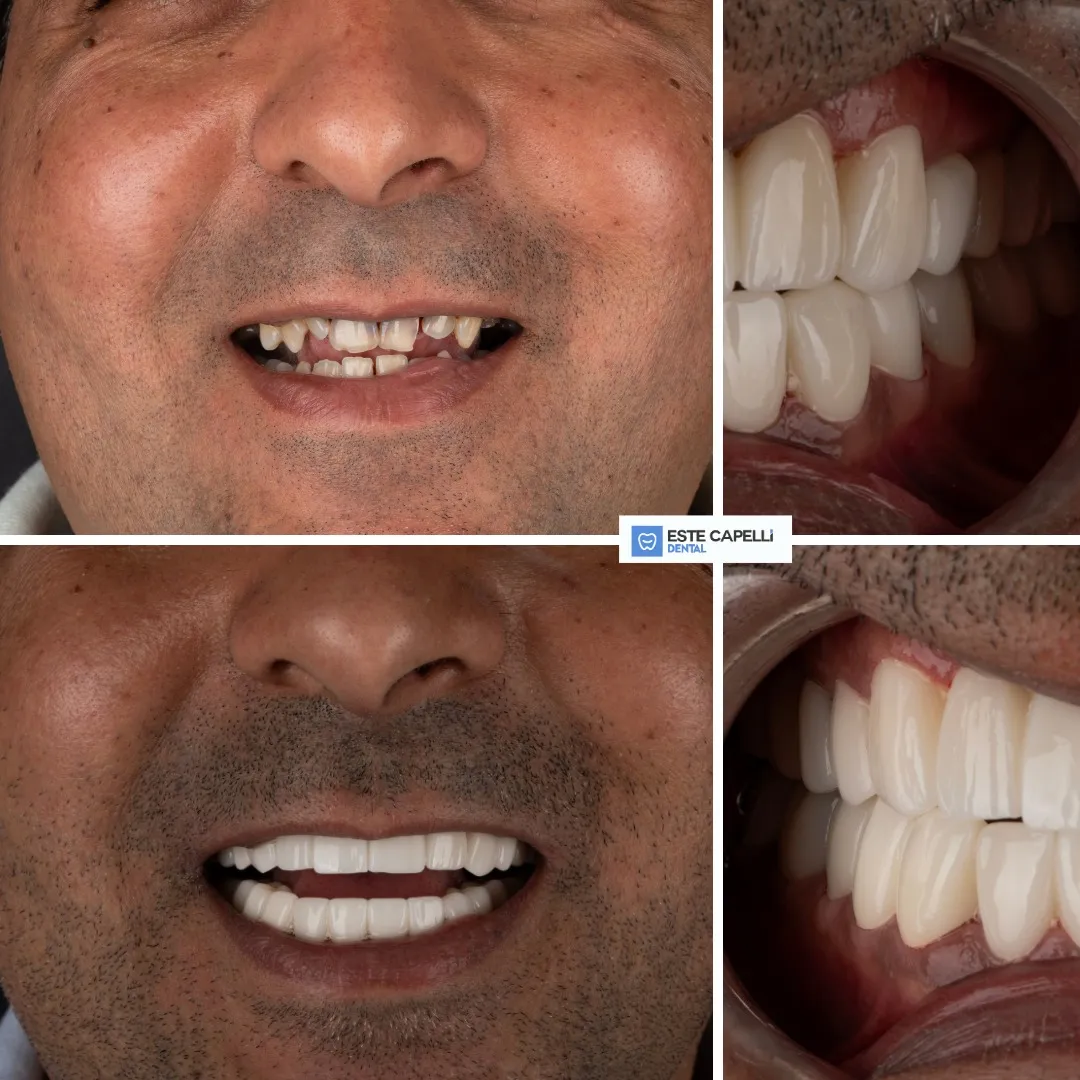 Before and after result