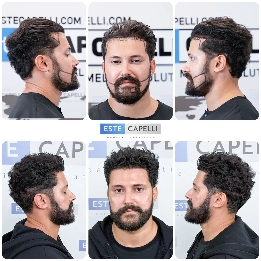 Before and after result