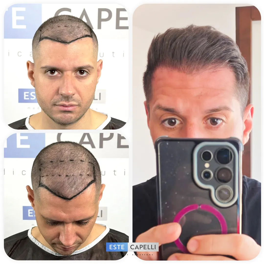 Before and after result
