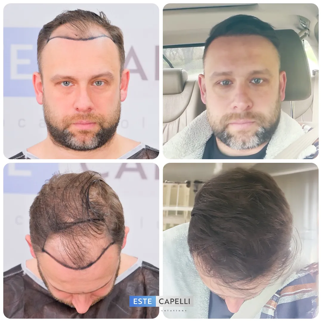 Before and after result