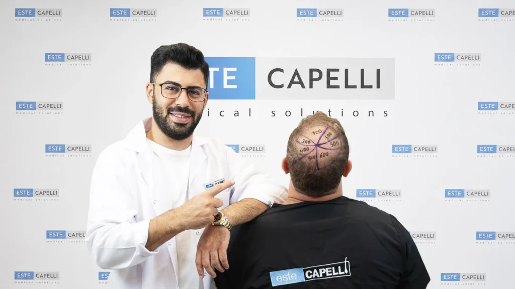surgeon planning the best hair transplant in Turkey