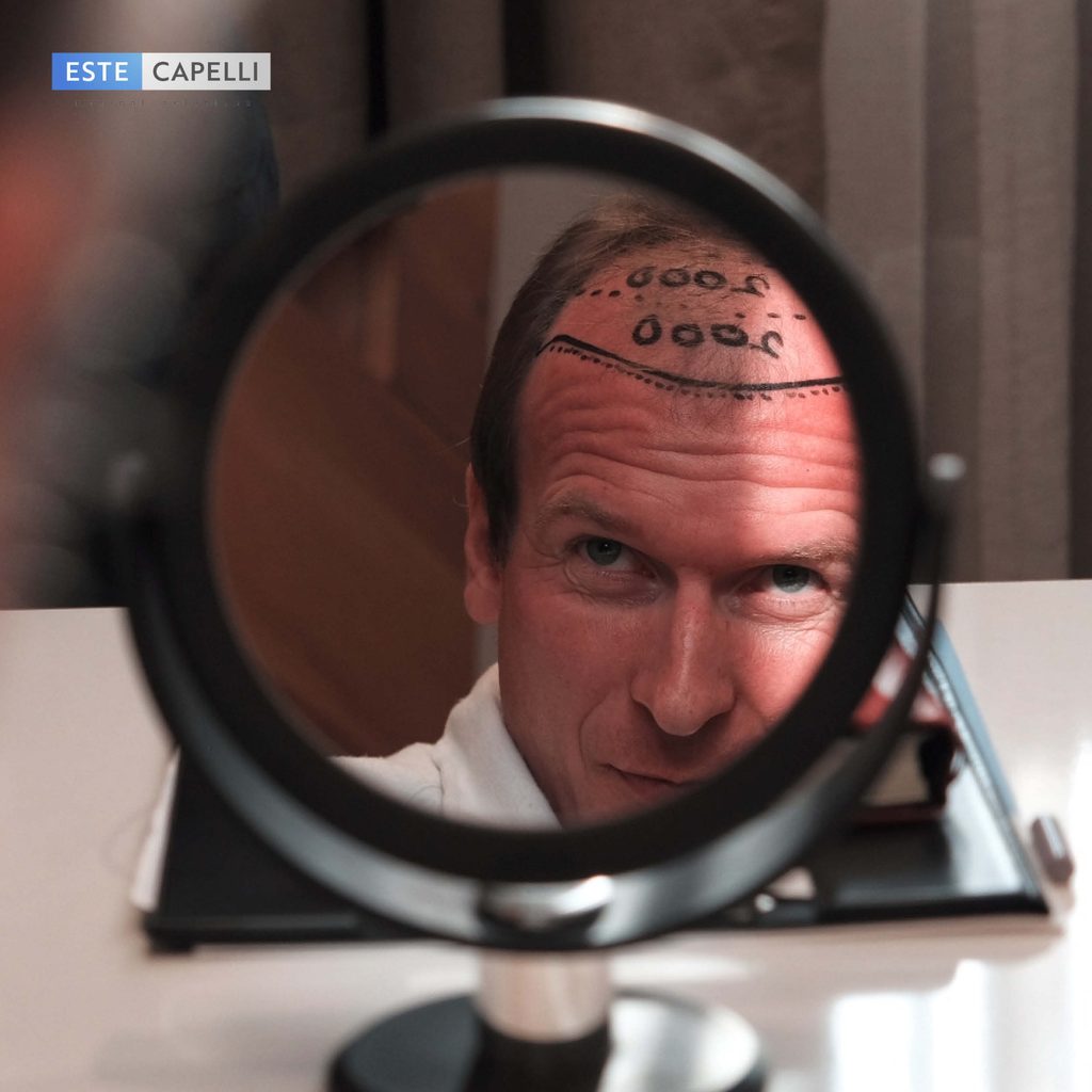 Hair transplant graft count: grafts sorted by 1, 2, 3 and 4 hairs under magnification